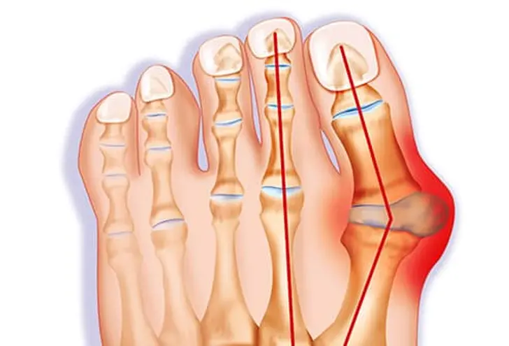 bunion