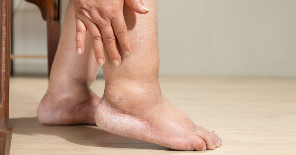 lymphedema