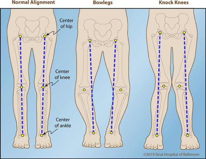 bowleg