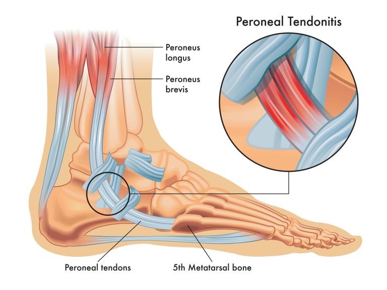 medical,illustrations,of,symptoms,of,peroneal,tendonitis,,with,enlargement,of